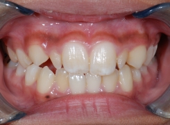 soin-dorthodontie-clinique-dentaire-st-charles-experts-en-orthodontie-pierrefond