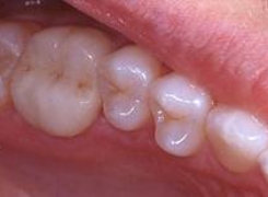 couronne-clinique-dentaire-saint-charles-specialistes-en-dentisterie-pierrefonds