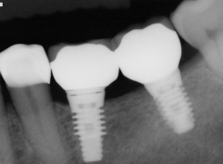implant-radio-service-de-chirurgie-et-dimplantologie-clinique-dentaire-st-charles-experts-dentistes-pierrefonds